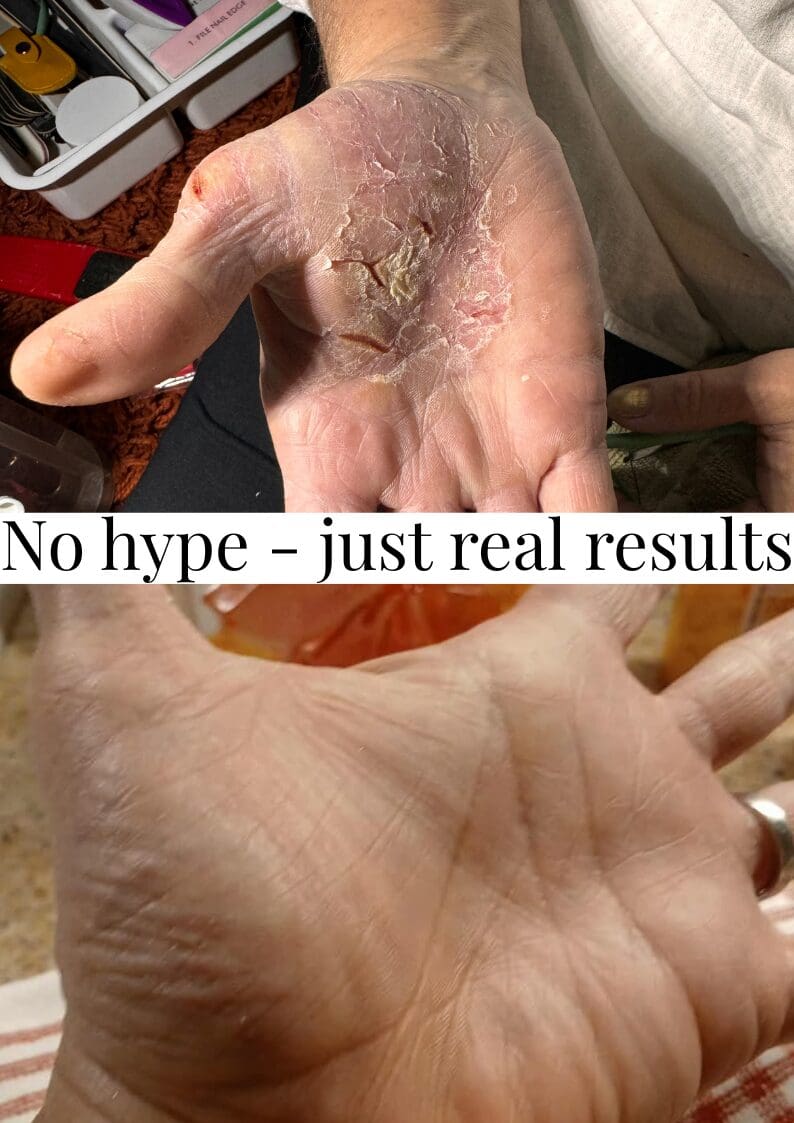 Palmar eczema, palmar psoriasis, cracking skin, winter skin